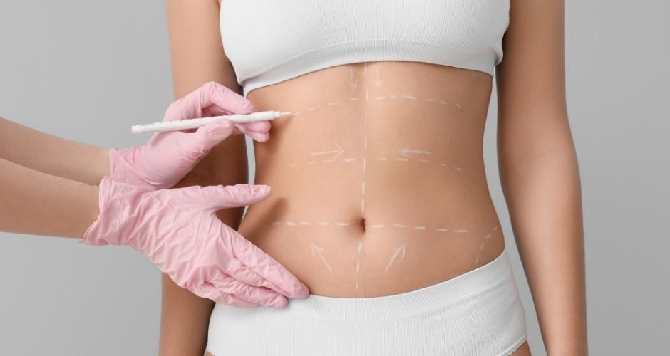 Lipoescultura
