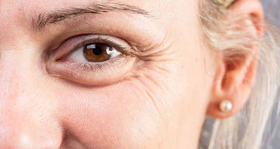 Tratar patas de gallo y líneas de expresión en ojos